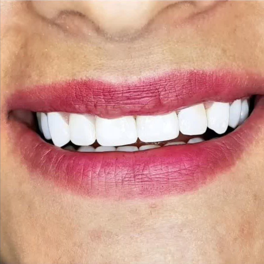 لبخند زیبا و دندان‌های کاملاً مرتب پس از اتمام موفقیت‌آمیز درمان ارتودنسی